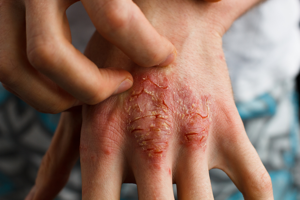 Burning and Itching Psoriasis