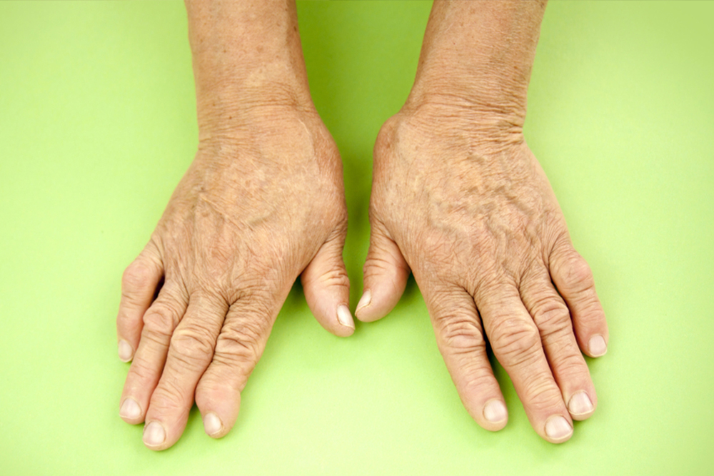 Nail and Joint Psoriasis
