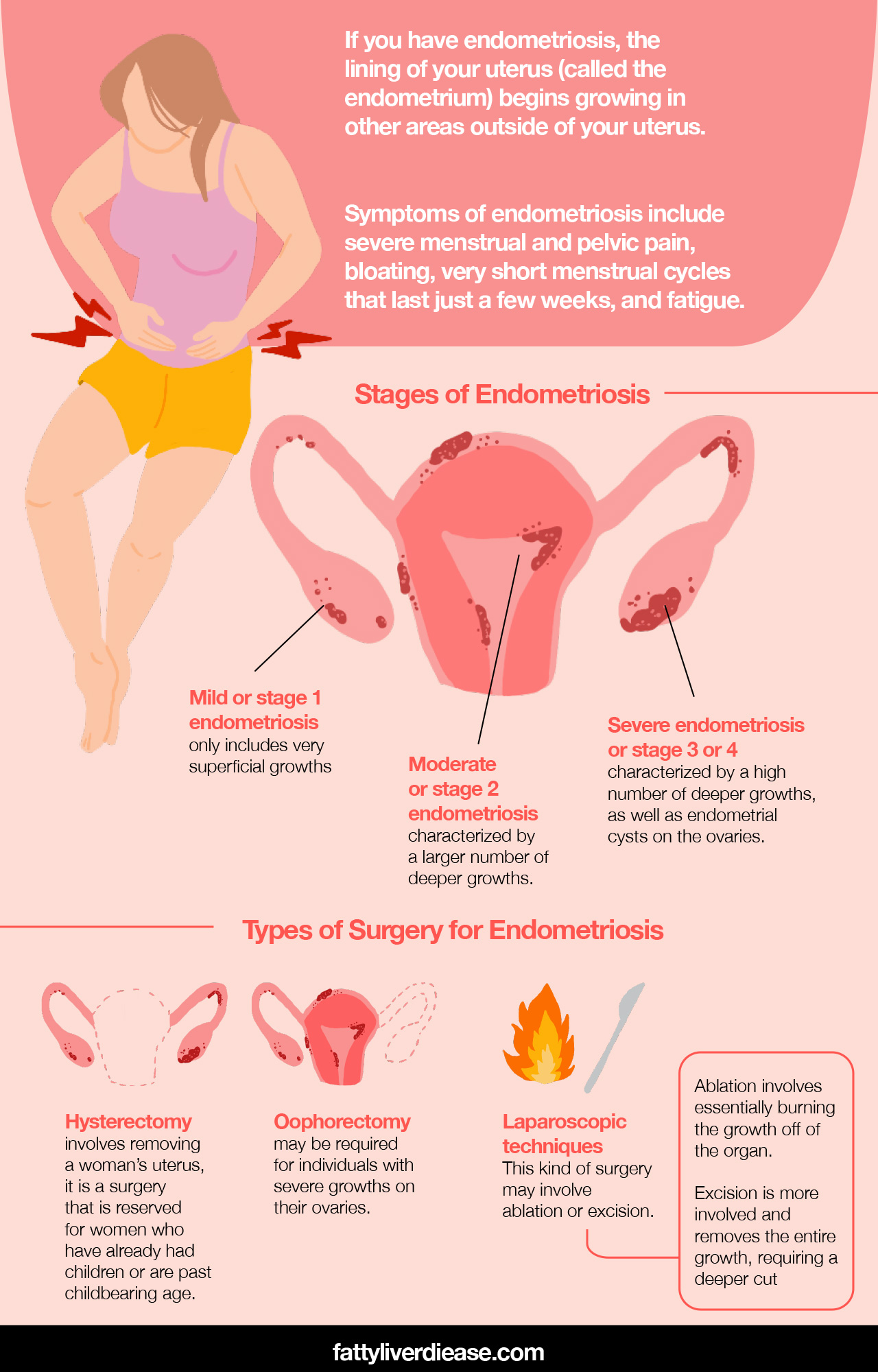 Stages of Endometriosis