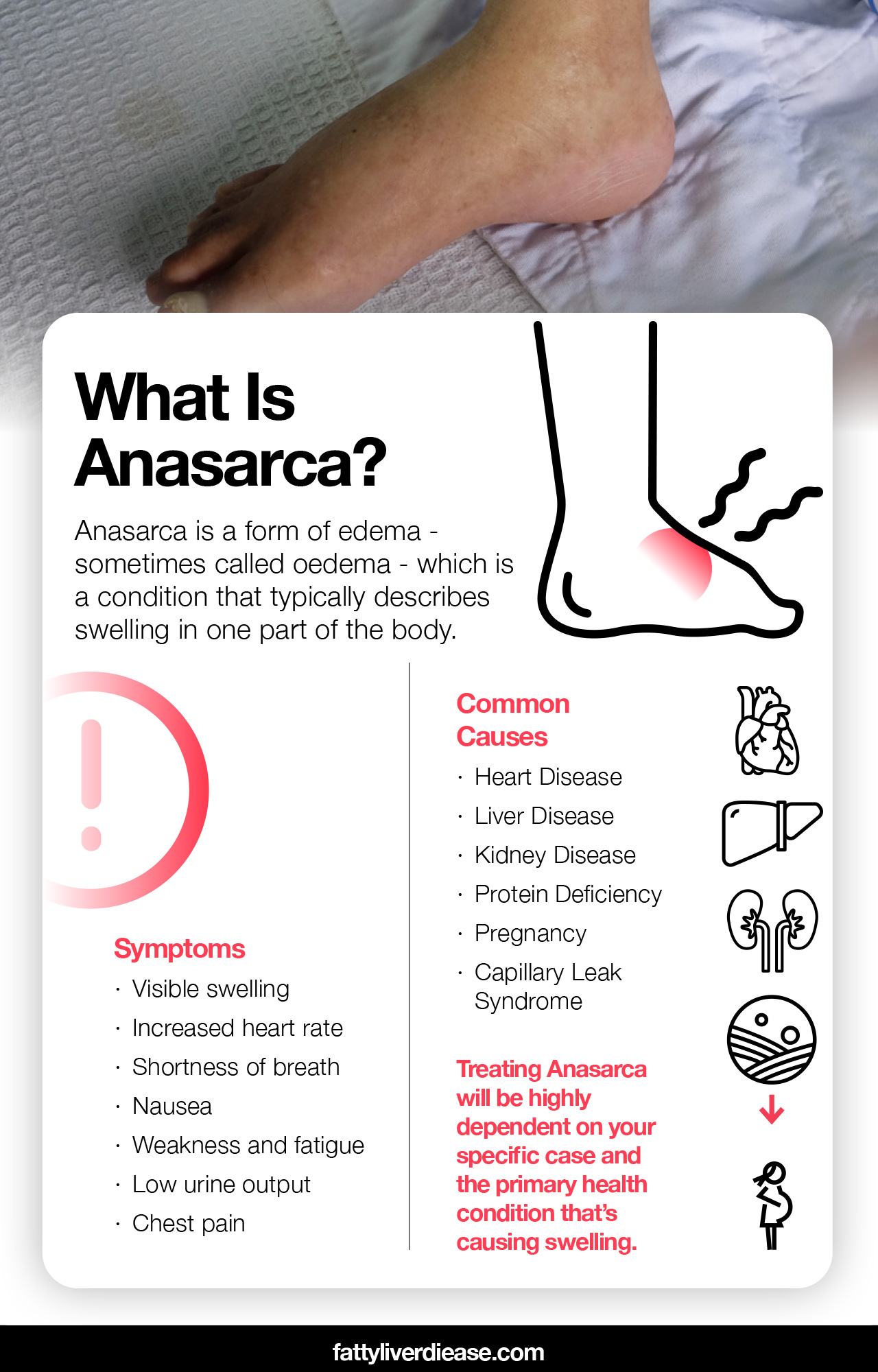 What You Need to Know About Anasarca